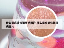 什么是点滴性银屑病图片 什么是点滴性银屑病图片