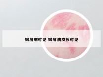 银屑病可见 银屑病皮损可见