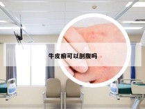 牛皮癣可以剖腹吗