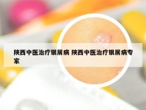 陕西中医治疗银屑病 陕西中医治疗银屑病专家