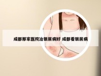 成都那家医院冶银屑病好 成都看银屑病