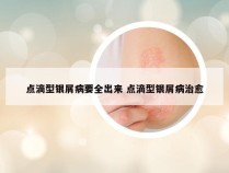 点滴型银屑病要全出来 点滴型银屑病治愈