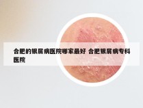 合肥的银屑病医院哪家最好 合肥银屑病专科医院