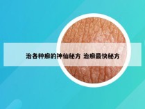 治各种癣的神仙秘方 治癣最快秘方