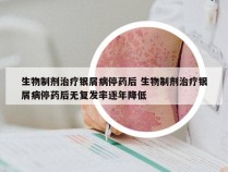 生物制剂治疗银屑病停药后 生物制剂治疗银屑病停药后无复发率逐年降低