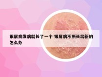 银屑病发病就长了一个 银屑病不断长出新的怎么办