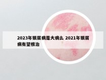 2023年银屑病是大病么 2021年银屑病有望根治