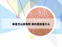 癣是怎么回事呢 癣的原因是什么