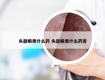 头部癣用什么药 头部癣用什么药膏