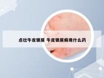 点壮牛皮银屑 牛皮银屑癣用什么药