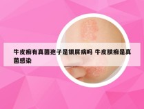 牛皮癣有真菌孢子是银屑病吗 牛皮肤癣是真菌感染