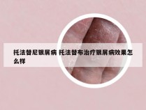 托法替尼银屑病 托法替布治疗银屑病效果怎么样