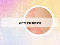 治疗牛皮癣案例文章