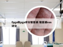 fpga和pga评分银屑病 银屑病vas评分