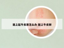 腿上起牛皮屑怎么办 腿上牛皮鲜