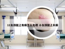 11女孩腿上有癣怎么处理 小女孩腿上长癣