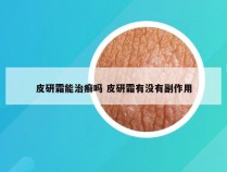 皮研霜能治癣吗 皮研霜有没有副作用