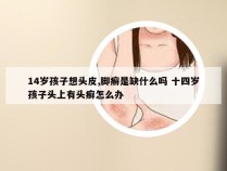 14岁孩子想头皮,脚癣是缺什么吗 十四岁孩子头上有头癣怎么办