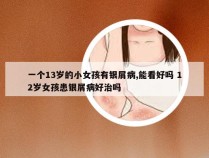 一个13岁的小女孩有银屑病,能看好吗 12岁女孩患银屑病好治吗