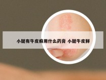 小腿有牛皮癣用什么药膏 小腿牛皮鲜