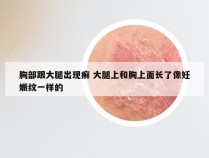 胸部跟大腿出现癣 大腿上和胸上面长了像妊娠纹一样的