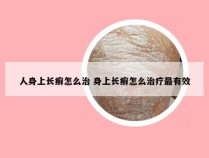 人身上长癣怎么治 身上长癣怎么治疗最有效