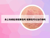 身上有癣能用硫磺皂吗 硫磺皂可以治疗癣吗