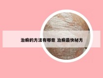 治癣的方法有哪些 治癣最快秘方