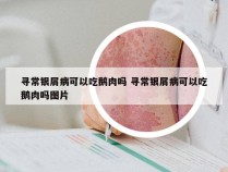 寻常银屑病可以吃鹅肉吗 寻常银屑病可以吃鹅肉吗图片