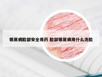 银屑病脸部安全用药 脸部银屑病用什么洗脸