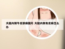 大腿内侧牛皮肤癣图片 大腿内侧有皮癣怎么办