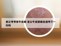 老公爷爷有牛皮癣 老公牛皮肤癣会遗传下一代吗