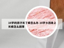 10岁的孩子长了癣怎么办 10岁小孩身上长癣怎么回事