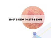 什么药治银屑病 什么药治银屑病好