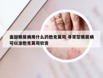 面部银屑病用什么药他克莫司 寻常型银屑病可以涂他克莫司软膏