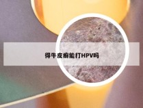 得牛皮癣能打HPV吗