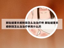 脚趾缝里长癣刺挠怎么治治疗啊 脚趾缝里长癣刺挠怎么治治疗啊用什么药