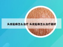 头皮起癣怎么治疗 头皮起癣怎么治疗最好