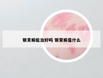 银宵癣能治好吗 银霄癣是什么