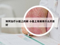 如何治疗小腿上的癣 小腿上有癣用什么药膏好