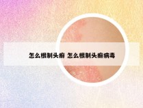 怎么根制头癣 怎么根制头癣病毒