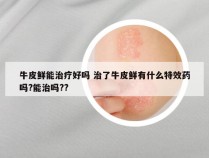 牛皮鲜能治疗好吗 治了牛皮鲜有什么特效药吗?能治吗??