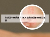 血燥型牛皮癣图片 银屑病血热型和血燥型区别