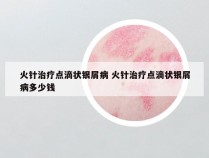 火针治疗点滴状银屑病 火针治疗点滴状银屑病多少钱