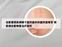 合肥看银屑病哪个医院最好的医院是哪家 银屑病合肥哪里治疗最好