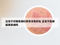 达克宁对银屑病红斑有没有好处 达克宁能缓解银屑病吗