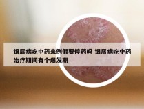 银屑病吃中药来例假要停药吗 银屑病吃中药治疗期间有个爆发期