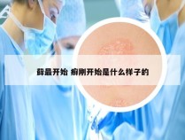 藓最开始 癣刚开始是什么样子的