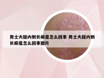 男士大腿内侧长癣是怎么回事 男士大腿内侧长癣是怎么回事图片