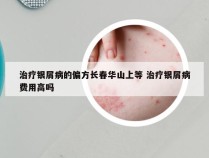 治疗银屑病的偏方长春华山上等 治疗银屑病费用高吗